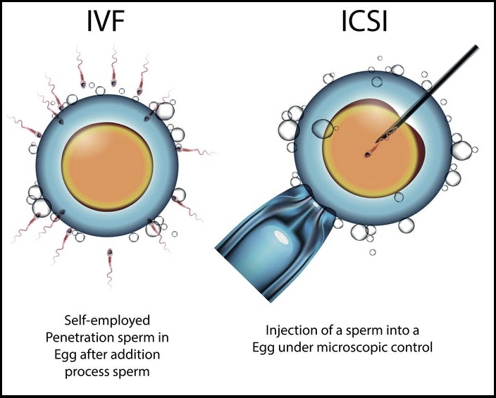 Fertility Centre in Junagadh	best ivf center in junagadh	ICSI treatment in Junagadh