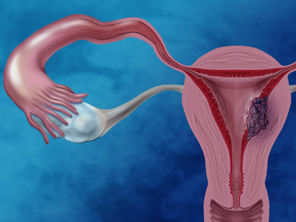 uterine tumors, fertility issues, infertility treatment, pregnancy complications, heavy menstruation, irregular cycles, fibroid removal, reproductive health, hormonal imbalance, IVF treatment, fertility centre in Junagadh, best IVF center in Junagadh, ICSI treatment in Junagadh, conception challenges, assisted reproductive techniques