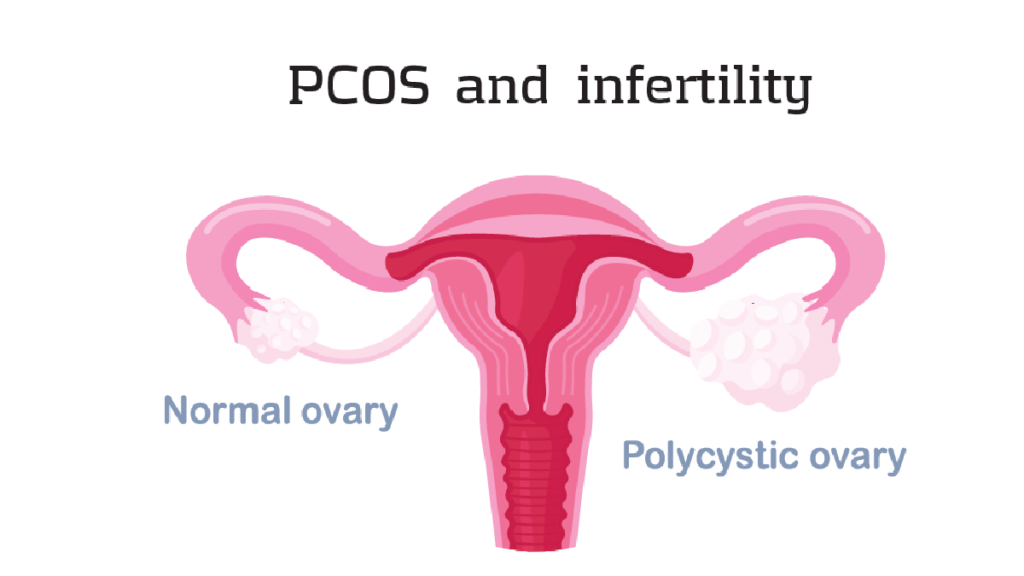 PCOS and fertility, IVF treatment for PCOS, best IVF centre in Junagadh, PCOS infertility treatment, PCOS pregnancy success, fertility treatment for PCOS, IVF success with PCOS, Unique IVF Centre Junagadh, best fertility clinic in Junagadh, IUI treatment for PCOS, PCOS-friendly diet, hormonal imbalance and infertility, ovulation induction for PCOS, PCOS weight management, assisted reproductive technologies, IVF specialists in Junagadh, PCOS and miscarriage prevention, egg quality improvement, infertility solutions for women