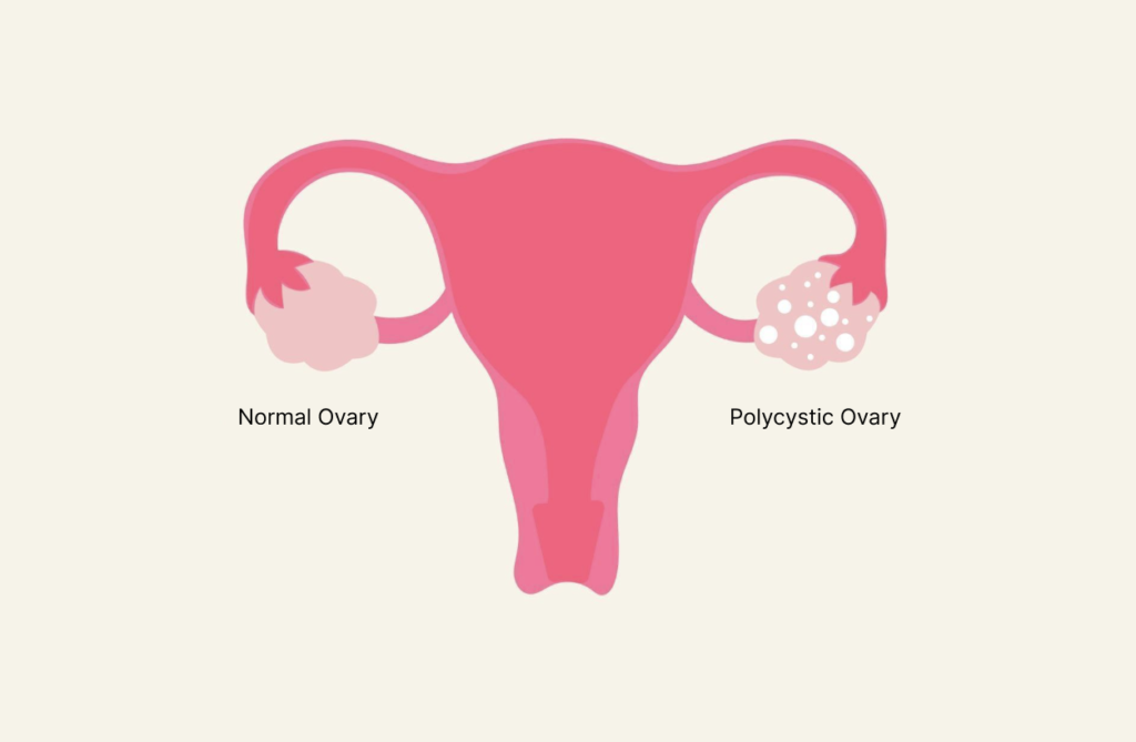 PCOD in women, PCOD treatment in Junagadh, fertility and PCOD, best IVF center in Junagadh, Unique IVF Hospital Junagadh, PCOD and infertility, ICSI treatment in Junagadh, hormonal imbalance in women, symptoms of PCOD, causes of PCOD, PCOD fertility solutions, IVF for PCOD patients, polycystic ovary disorder treatment, PCOD lifestyle management, PCOD diagnosis Junagadh