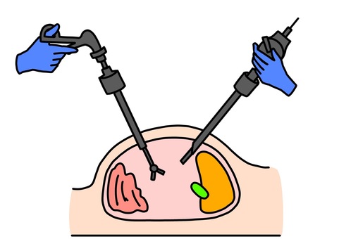 stitchless surgery Junagadh, laparoscopic surgery without stitches, keyhole surgery Junagadh, minimally invasive gynecological surgery, best IVF center in Junagadh, laparoscopic fertility surgery, stitchless fibroid removal, laparoscopic endometriosis treatment, blocked fallopian tube surgery, Unique IVF Hospital Junagadh, ICSI treatment Junagadh, advanced fertility treatment Junagadh, laparoscopic uterus surgery, gynec laparoscopy Junagadh