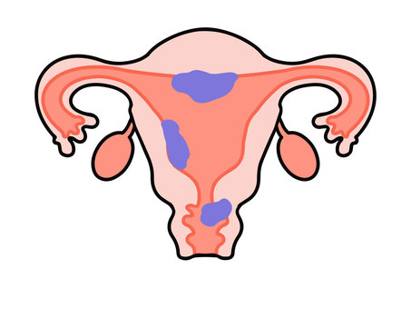 uterine cancer symptoms, early signs of uterine cancer, endometrial cancer awareness, fertility centre in Junagadh, best IVF center in Junagadh, Unique IVF Hospital, ICSI treatment Junagadh, women’s reproductive health, gynecology hospital Junagadh, postmenopausal bleeding, uterine cancer diagnosis, reproductive health care