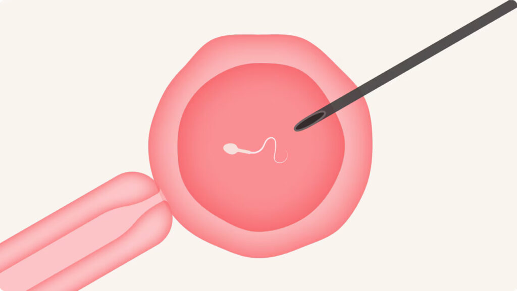 pregnant without ovulation, IVF in Junagadh, ICSI treatment in Junagadh, fertility centre in Junagadh, best IVF center in Junagadh, no ovulation pregnancy, PCOS infertility treatment, hormonal infertility, IVF process explained, Unique IVF Hospital Junagadh, assisted reproduction Junagadh, infertility solutions for women