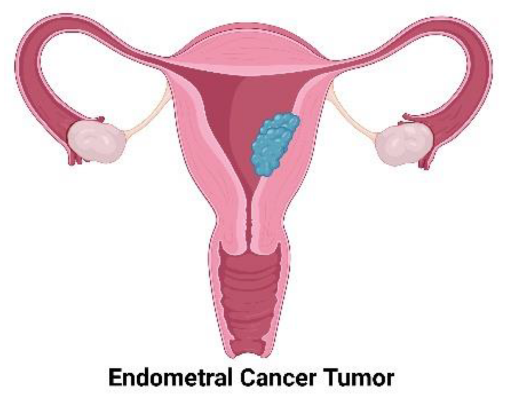 gynecological cancers, ovarian cancer awareness, cervical cancer prevention, uterine cancer symptoms, best IVF center in Junagadh, Unique IVF Hospital Junagadh, ICSI treatment in Junagadh, women's reproductive health Junagadh, HPV and cervical cancer, gynecology and fertility care, vulvar cancer symptoms, vaginal cancer screening, early detection of female cancers, endometrial cancer diagnosis, fertility centre Junagadh, cancer screening for women, holistic women’s health care