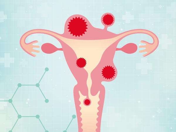 gynecological cancers, ovarian cancer awareness, cervical cancer prevention, uterine cancer symptoms, best IVF center in Junagadh, Unique IVF Hospital Junagadh, ICSI treatment in Junagadh, women's reproductive health Junagadh, HPV and cervical cancer, gynecology and fertility care, vulvar cancer symptoms, vaginal cancer screening, early detection of female cancers, endometrial cancer diagnosis, fertility centre Junagadh, cancer screening for women, holistic women’s health care