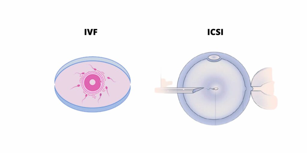 IVF treatment Junagadh, ICSI treatment Junagadh, best IVF center Junagadh, fertility centre Junagadh, infertility solutions, assisted reproductive technology, male infertility treatment, female infertility treatment, egg retrieval Junagadh, embryo transfer Junagadh